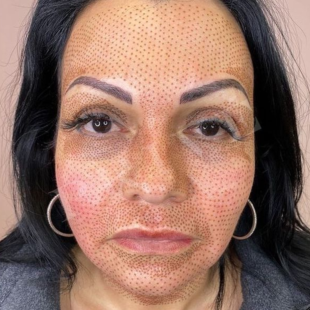 FIBROBLAST ANTI-WRINKLE - UPPER / LOWER EYE