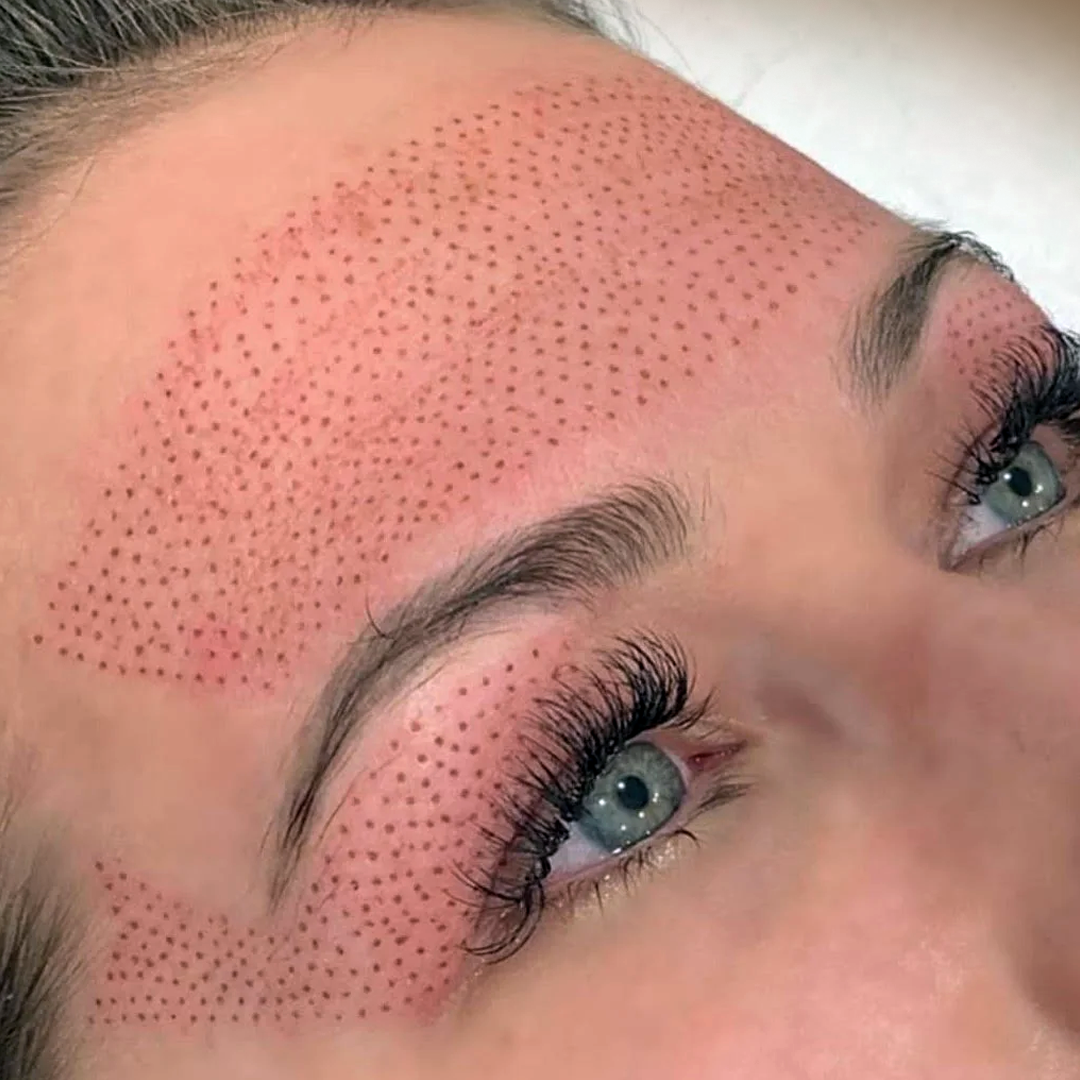 FIBROBLAST ANTI-WRINKLE - FOREHEAD