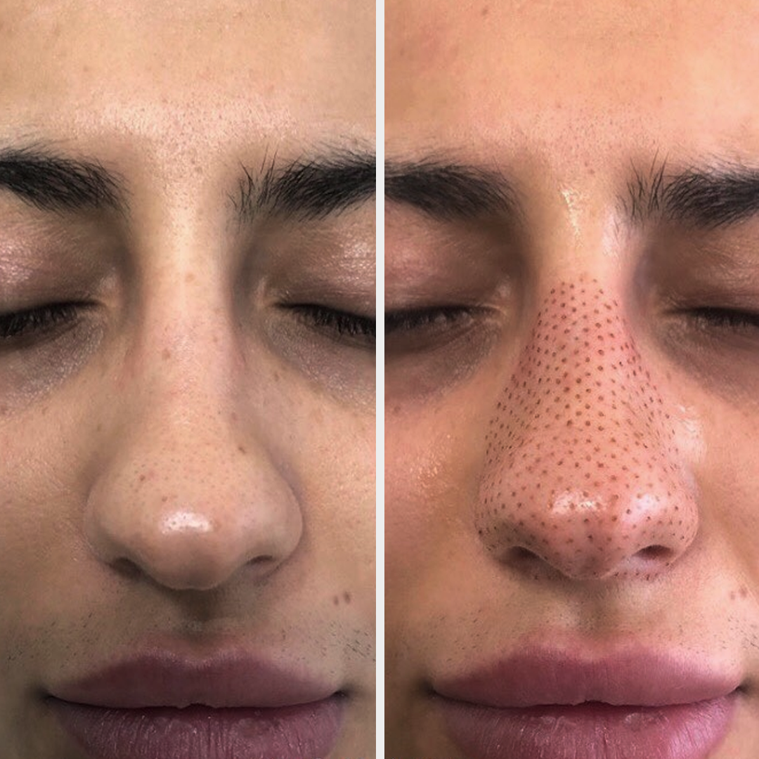 FIBROBLAST ANTI-WRINKLE - NOSE DEFINITION