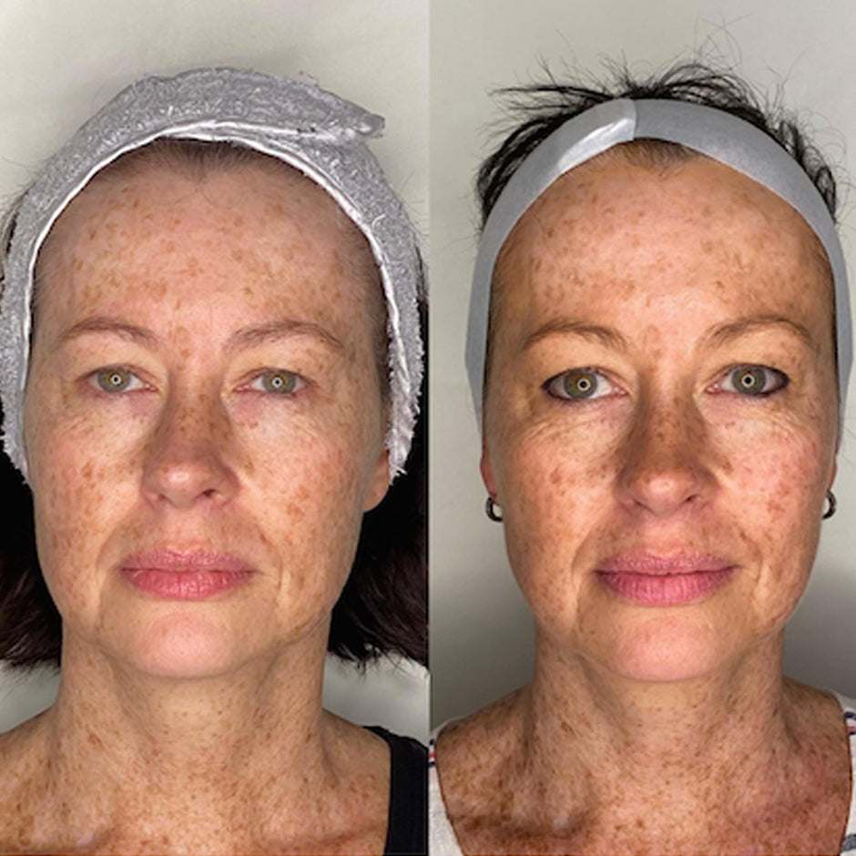 HIFU NON-SURGICAL EYEBROW LIFT