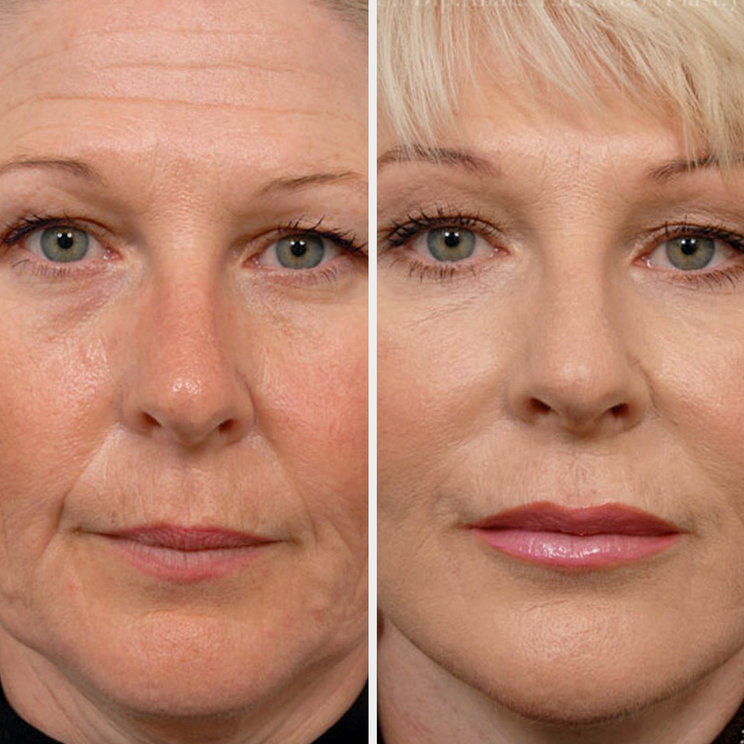 HIFU NON-SURGICAL EYEBROW LIFT
