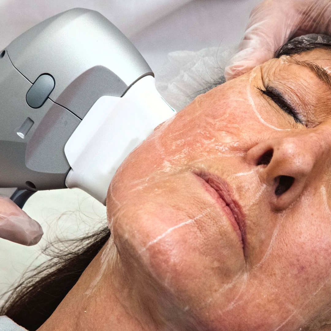 HIFU NON-SURGICAL FACE LIFT
