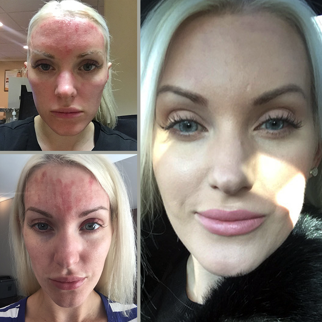 PLATINUM RF SKIN TIGHTENING