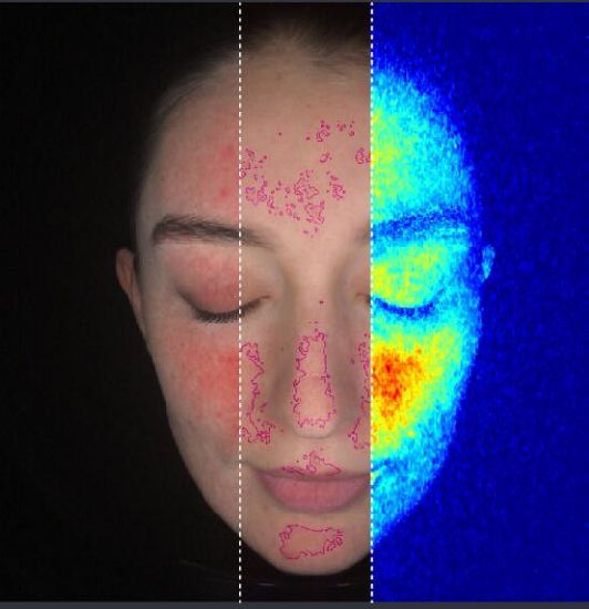 SCANX SKIN ANALYSIS