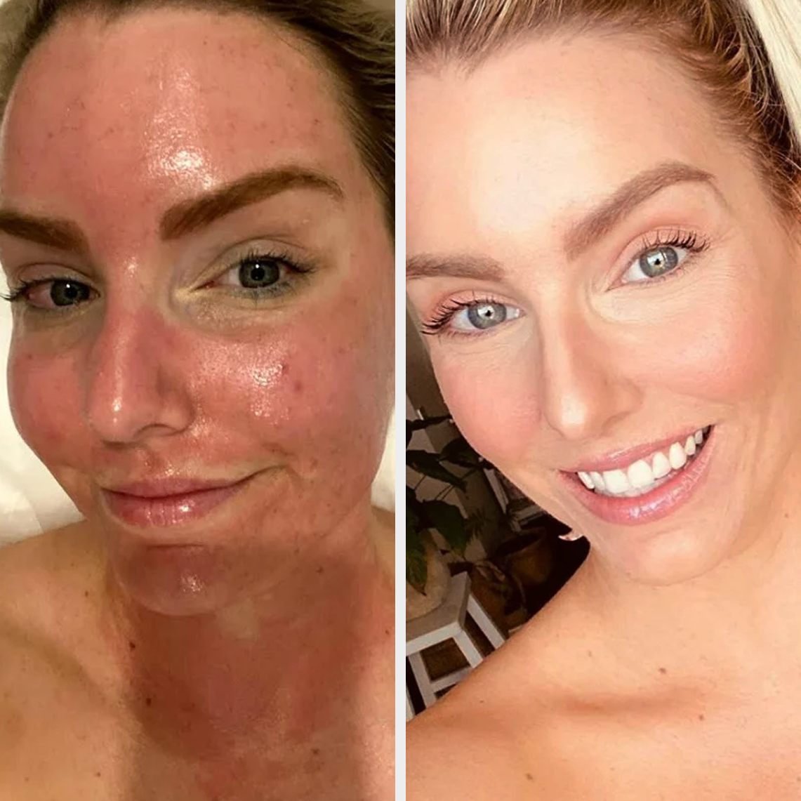 PLATINUM RF SKIN TIGHTENING