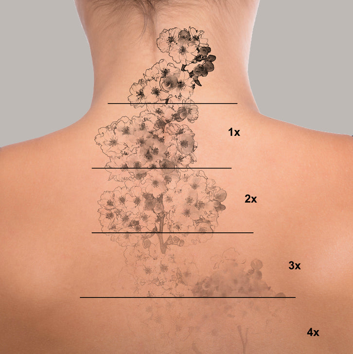 ADVANCED TATTOO REMOVAL