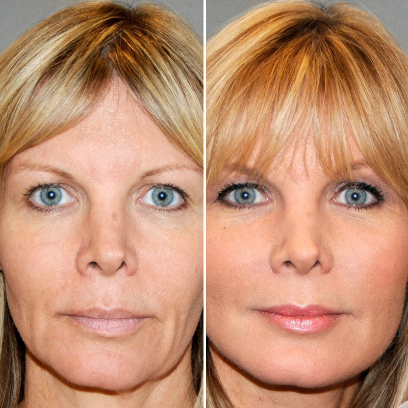 HIFU NON-SURGICAL FACE LIFT